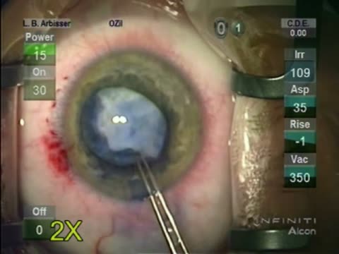 Traumatic Leukocoria