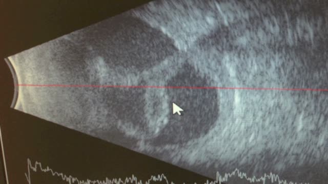 Triple Procedure - Scleral Buckle, Phacoemulsification with IOL and Vitrectomy For Failed Diabetic Tractional Retinal Detachment