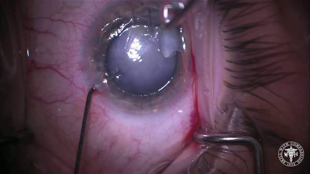 Traumatic Cataract Removal after Nail Injury to Anterior and Posterior Lens Capsule