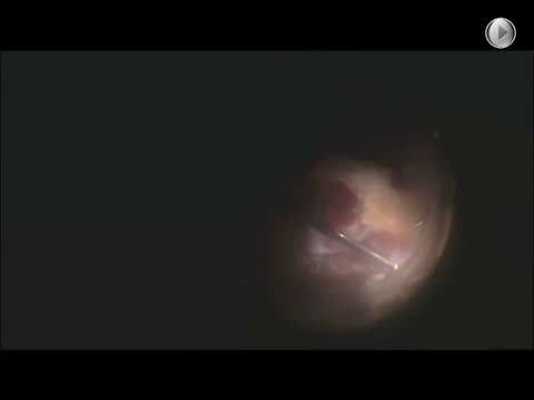 Unimanual Diabetic Tractional Retinal Detachment Repair