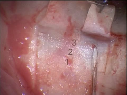 Where to Implant the EX-PRESS Device?