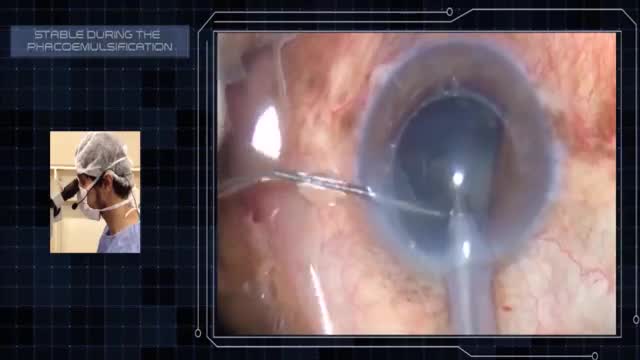 Canabrava's Ring - The First Intraocular 3D Printed Device