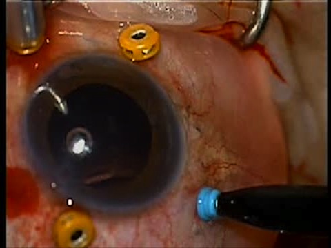 Bimanual Approach to Intraocular lens Rescue Using Modified Transconjunctival Scleral Fixation