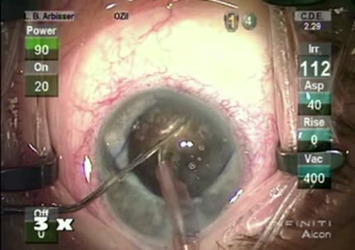 Brunescent Circumferential Disassembly