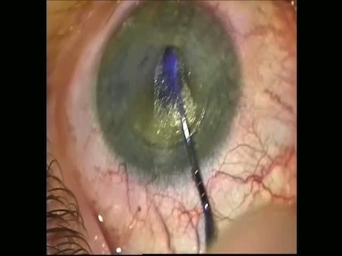 Small-incision Lenticule Extraction