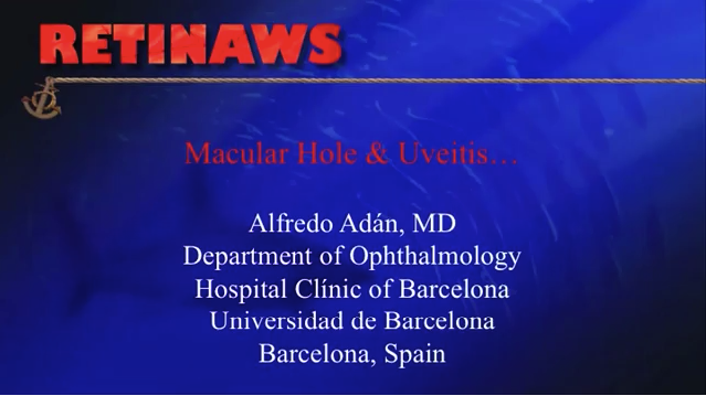Macular Hole & Uveitis
