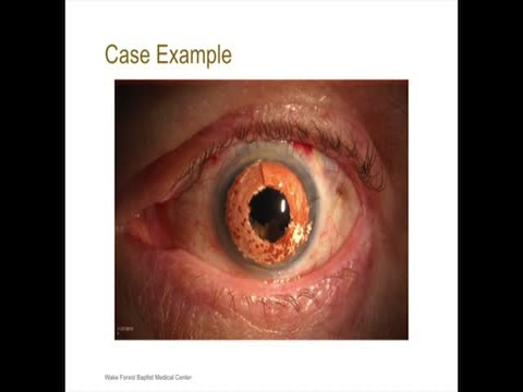 Femto Assisted Corneal Tattoo