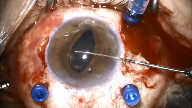 Iris Fixation of Dislocated PMMA Lens