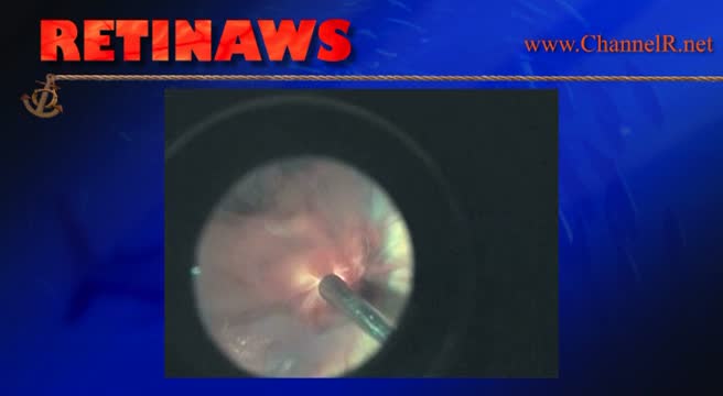 Multi-Layered Hemorrhage