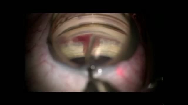 New Technique for Ab Interno Canaloplasty using 25g MVR blade to open Schlemms Canal