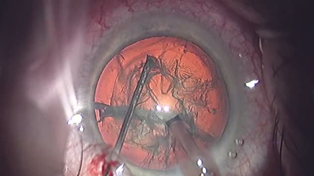 Phaco Chop Cataract Surgery