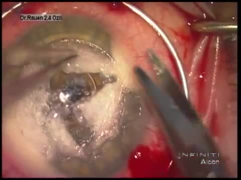 Cornea Transplantation by DALK using Big Bubble