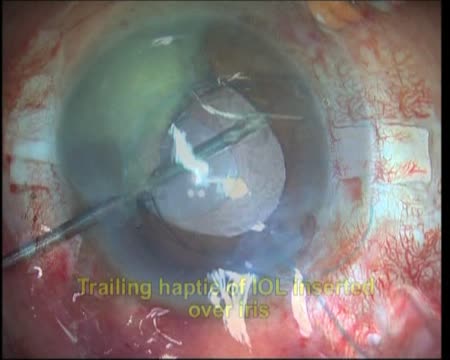 IOL Scaffold: A plethora of indications
