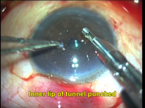 Stab Incision Glaucoma Surgery or SIGS