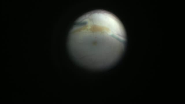 Pediatric Terson Syndrome