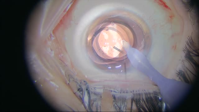 Dysfunctional Lens Replacement with Femtosecond Laser Followed by Same Day Slit Lamp Evaluation 