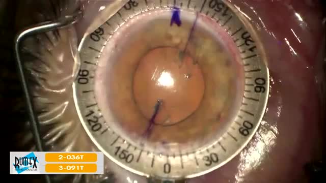 Degree Gauge and Axis Marker for IOL Placement