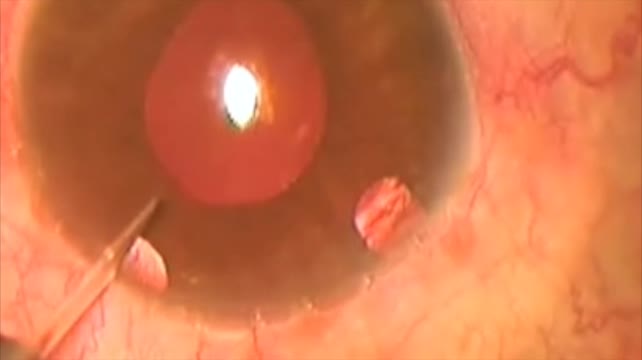Microtrack Filtration in a Case of Intracapsular Aphake