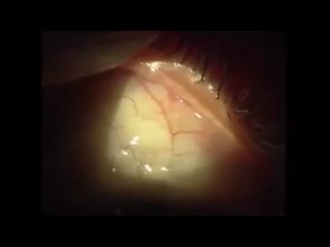 Trans-Corneal Needling of a Filtering Bleb