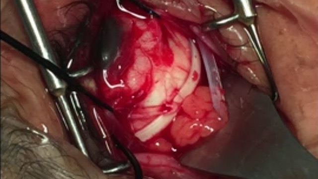 How to Treat Accidental Orbital Fat Extrusion During Scleral Buckling