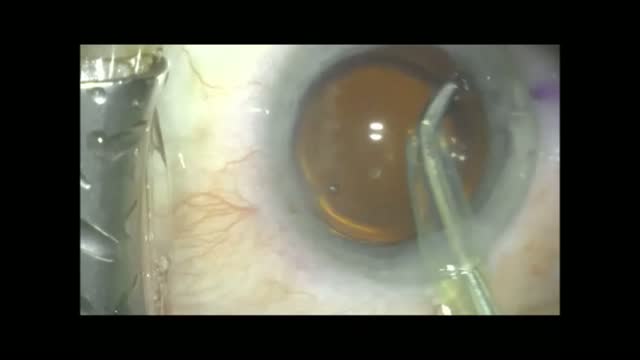 Supracapsular Flip & Slice 