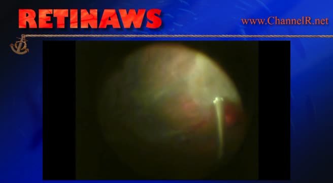 Capillary Hemangioma