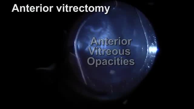 Vitrectomy for Floaters