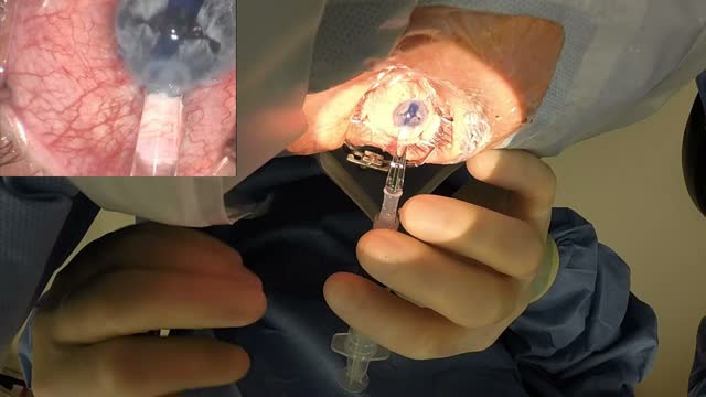 GoPro Wide View of DMEK Injection Using a Modified Jones Tube