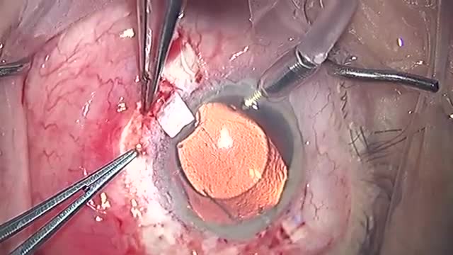 Dislocated IOL Exchange with Modified Scleral Glued IOL Technique