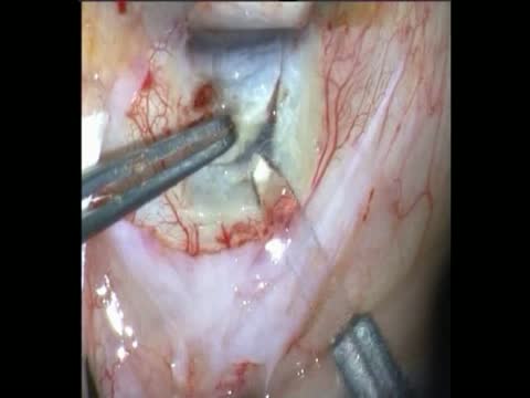 Needle Viscocanalostomy