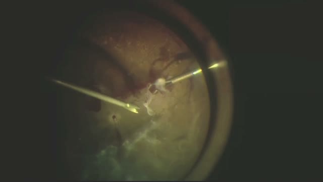 Bimanual Diabetic Tractional Retina Detachment Repair