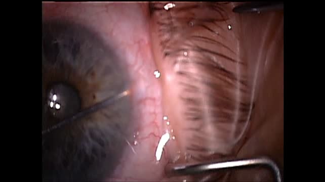 Internal Revision for a Closed Trabeculectomy Flap