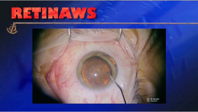 Hypotony Maculopathy