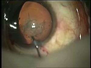 Capsulorrhexis Rescue