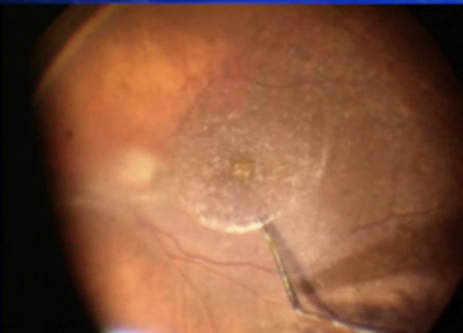 Vitreomacular Traction Syndrome 