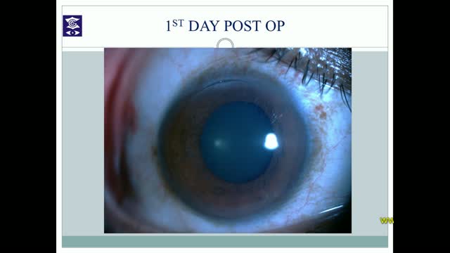 Femtosecond Laser Intrastromal Lenticular Implantation