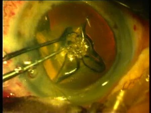Classification of Femtosecond Capsulotomy Tags