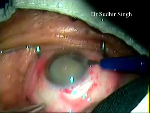 MSICS in White Cataract