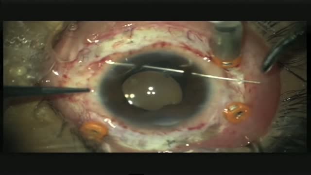 Pars-plana Lensectomy, Intrascleral Tunnel IOL Fixation and Pupilloplasty Following Severe Blunt Trauma
