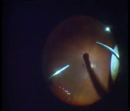 Extraction of Dropped Nucleus with ICCE and Retropupillary Verisyse IOL