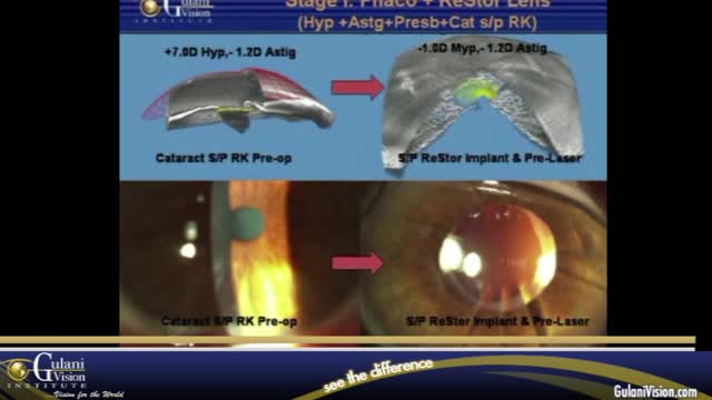 Multifocal IOL and Advanced Surface Ablation Combination for Radial Keratotomy: Reversing the Past