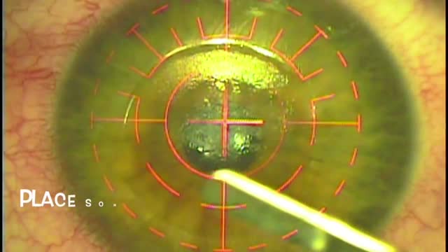 Phototherapeutic Keratectomy
