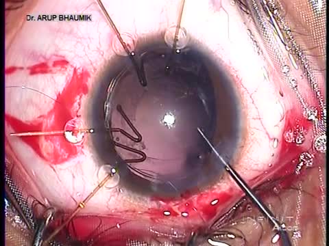 Management of Subluxated Cataracts