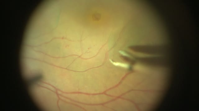 Macular Hole Repair