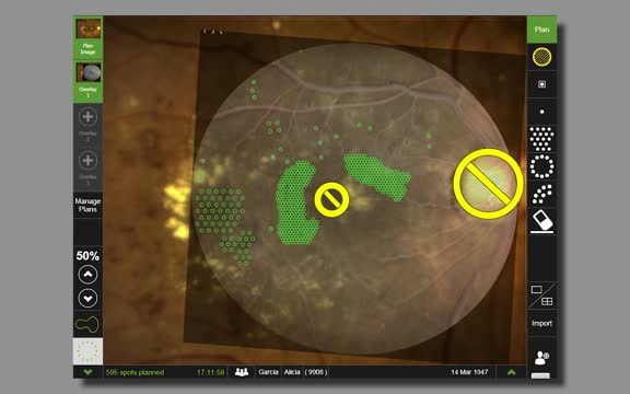 Navigated Microsecond Treatment for DME: Case Presentation