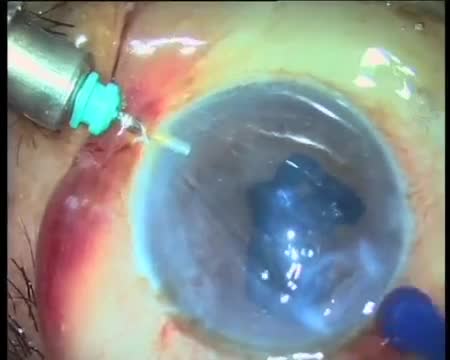 PDEK Live Surgery
