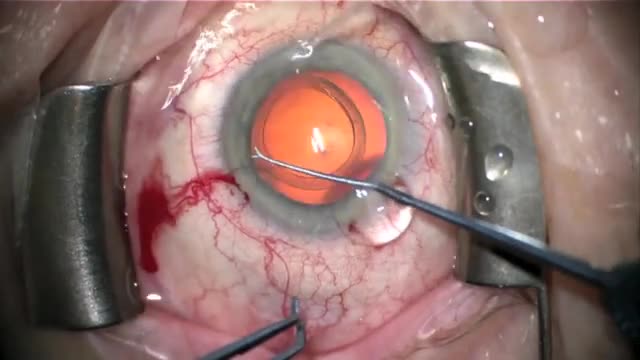 VERUS Ophthalmic Caliper