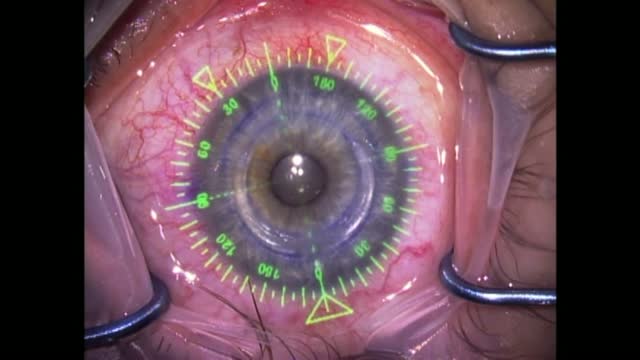 Intracorneal Ring Segments Using Verion system