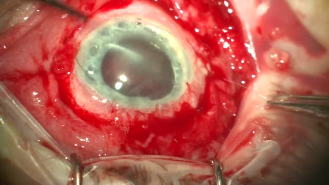 MiraGel Implant Removal Following Partial Removal 