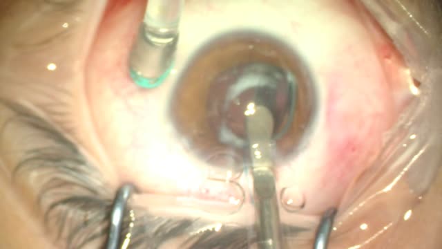 Removal of Dislocated IOL; Placement of Three-Piece Sulcus IOL; Pars Plana Vitrectomy (PPV)